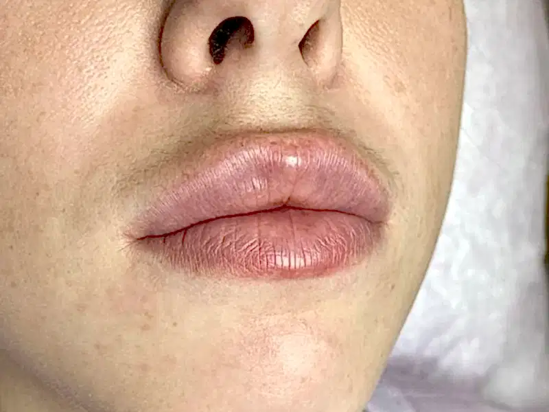 Контурная пластика губ