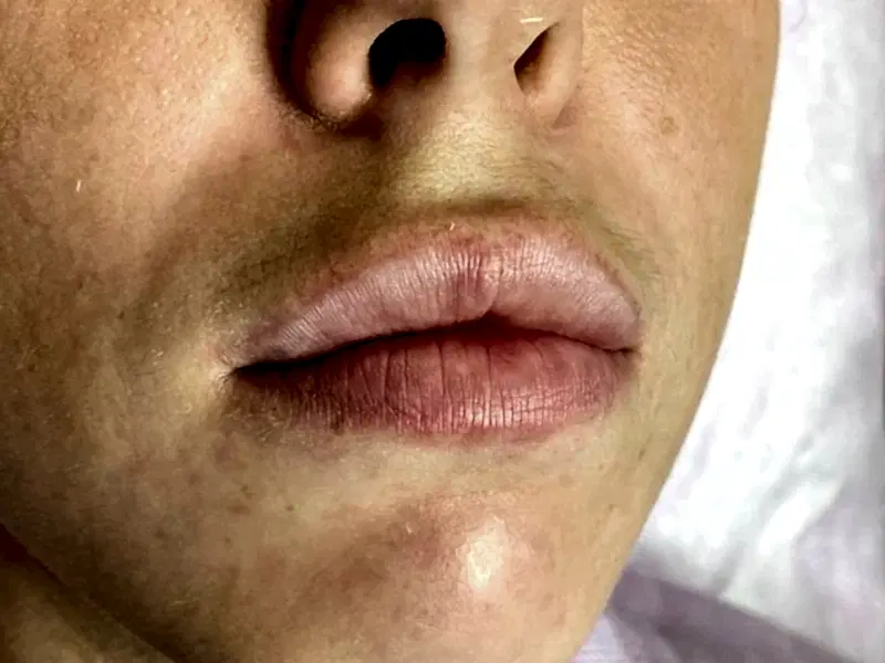 Контурная пластика губ