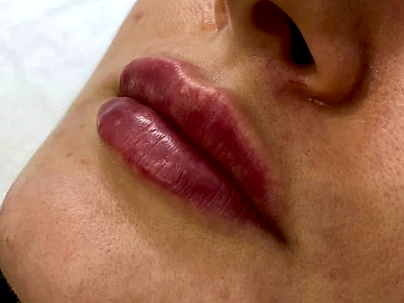 Контурная пластика губ